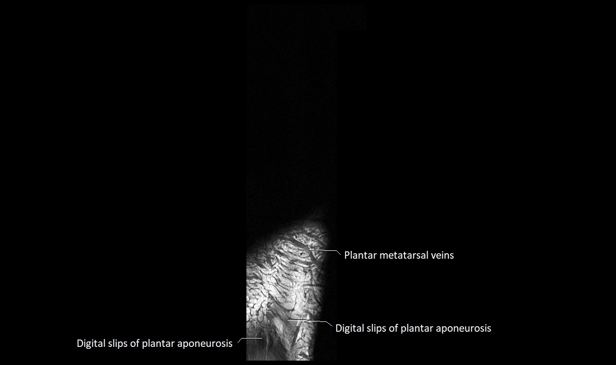 Great Toe micro anatomy MRI axial cross sectional 3T image 29.webp